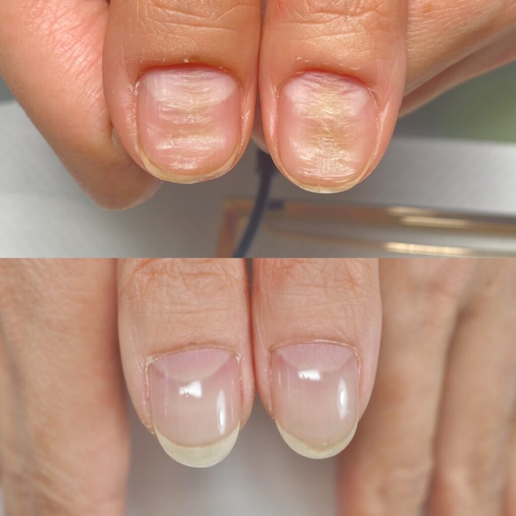 自爪育成の施術後（After）の健康的な爪の状態