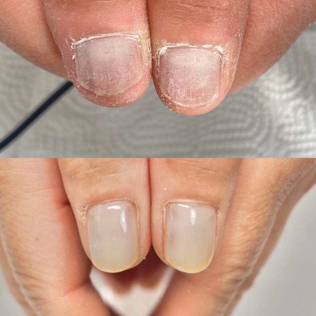 自爪育成の施術前（Before）の爪の状態