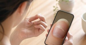 高崎で爪剥離に悩む人が原因と対応方法を確認するイメージ画像